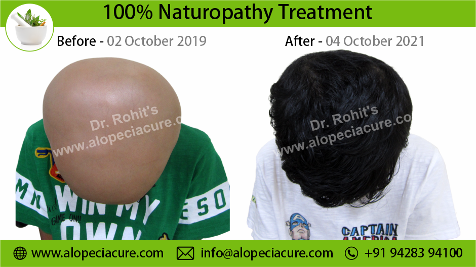 alopecia areata treatment Hyderabad